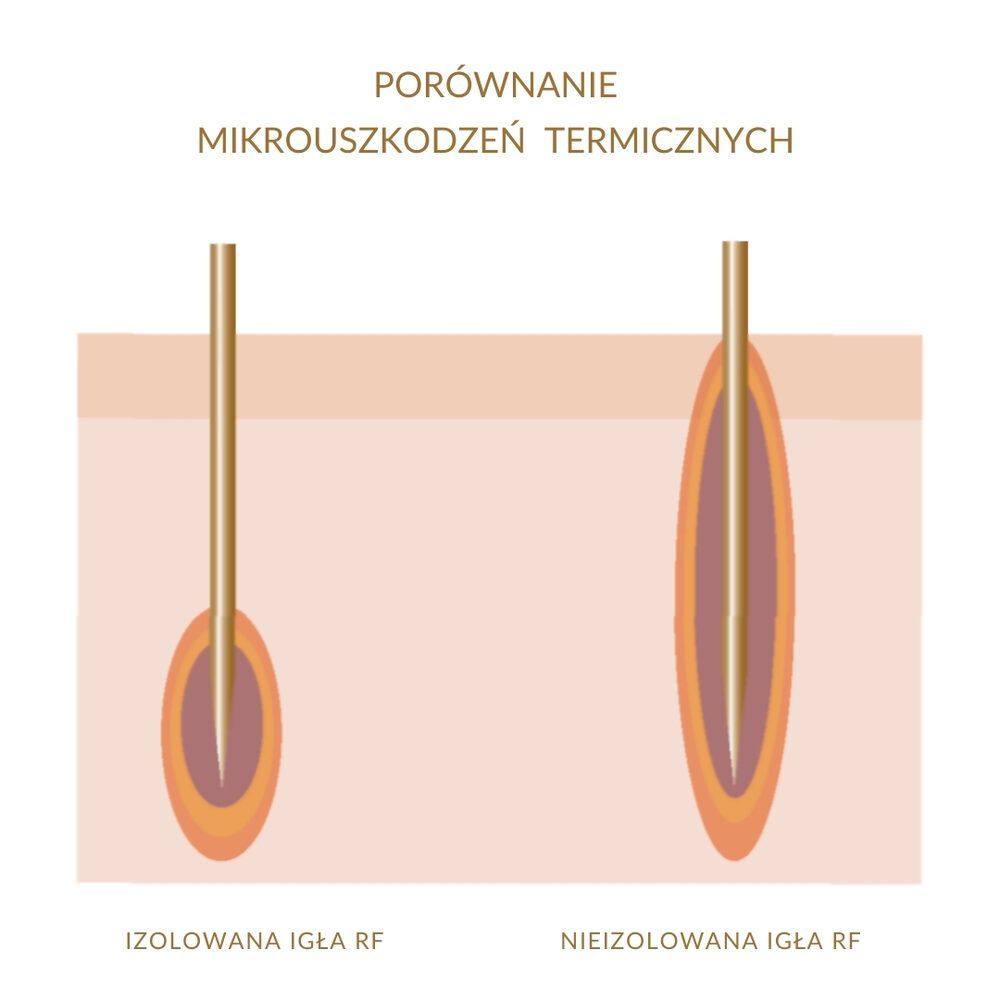 Portfolio usługi Radiofrekwencja (RF) Mikroigłowa  - Niechirurgi...