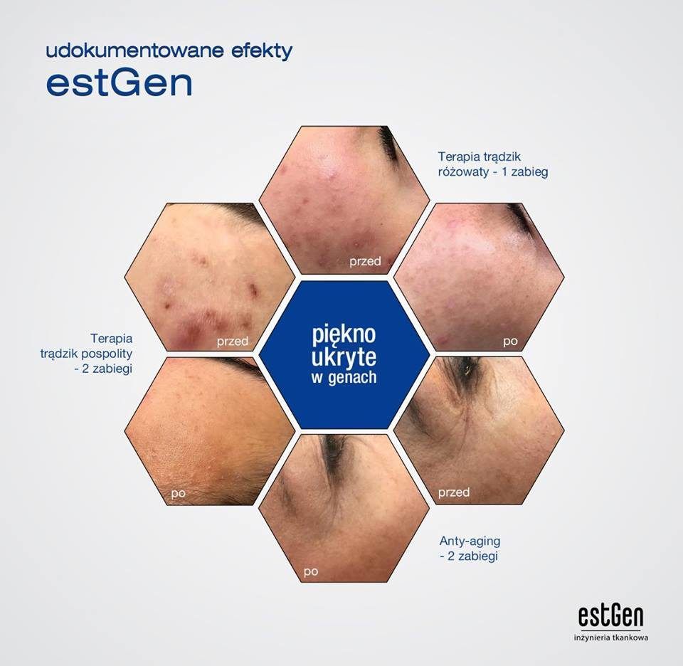 Portfolio usługi EstGen Anti-aging, odbudowa i zagęszczenie skór...