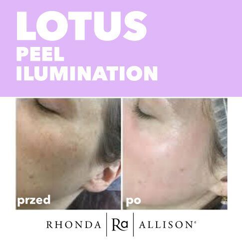 Portfolio usługi Lotus Peel Ilumination