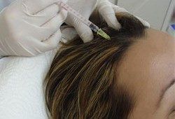 Portfolio usługi Mezoterapia igłowa skóry głowy