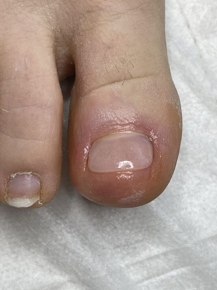 Portfolio usługi Rekonstrukcja paznokcia u stopy