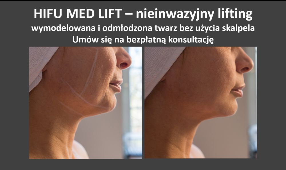 Portfolio usługi HIFU MED LIFT - Cała twarz + Szyja