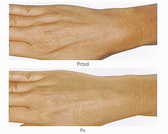 Portfolio usługi Zabieg Mezoterapii Mikroigłowej na dłonie