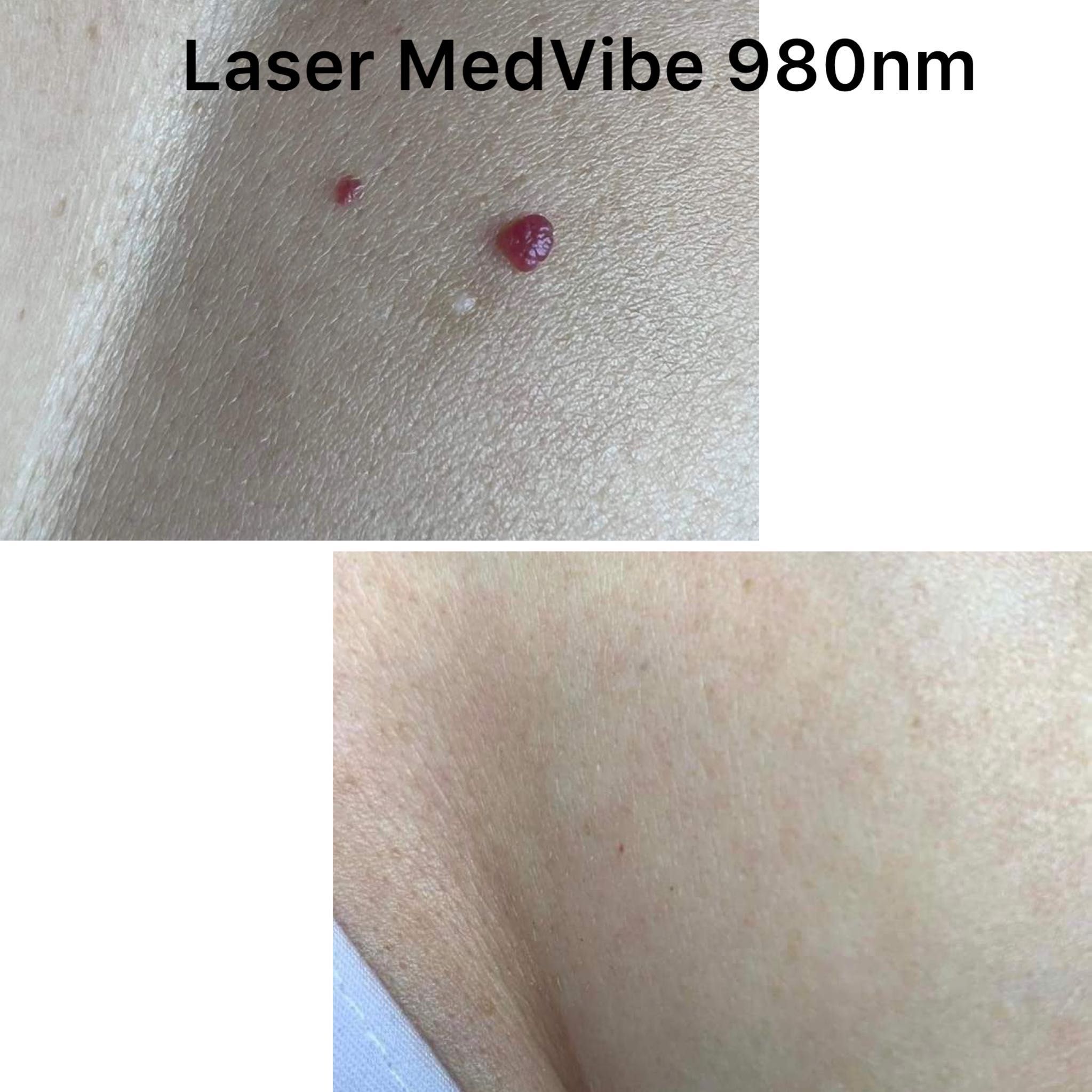 Portfolio usługi Laserowe zamykanie naczynek Laser MedVibe 980nm