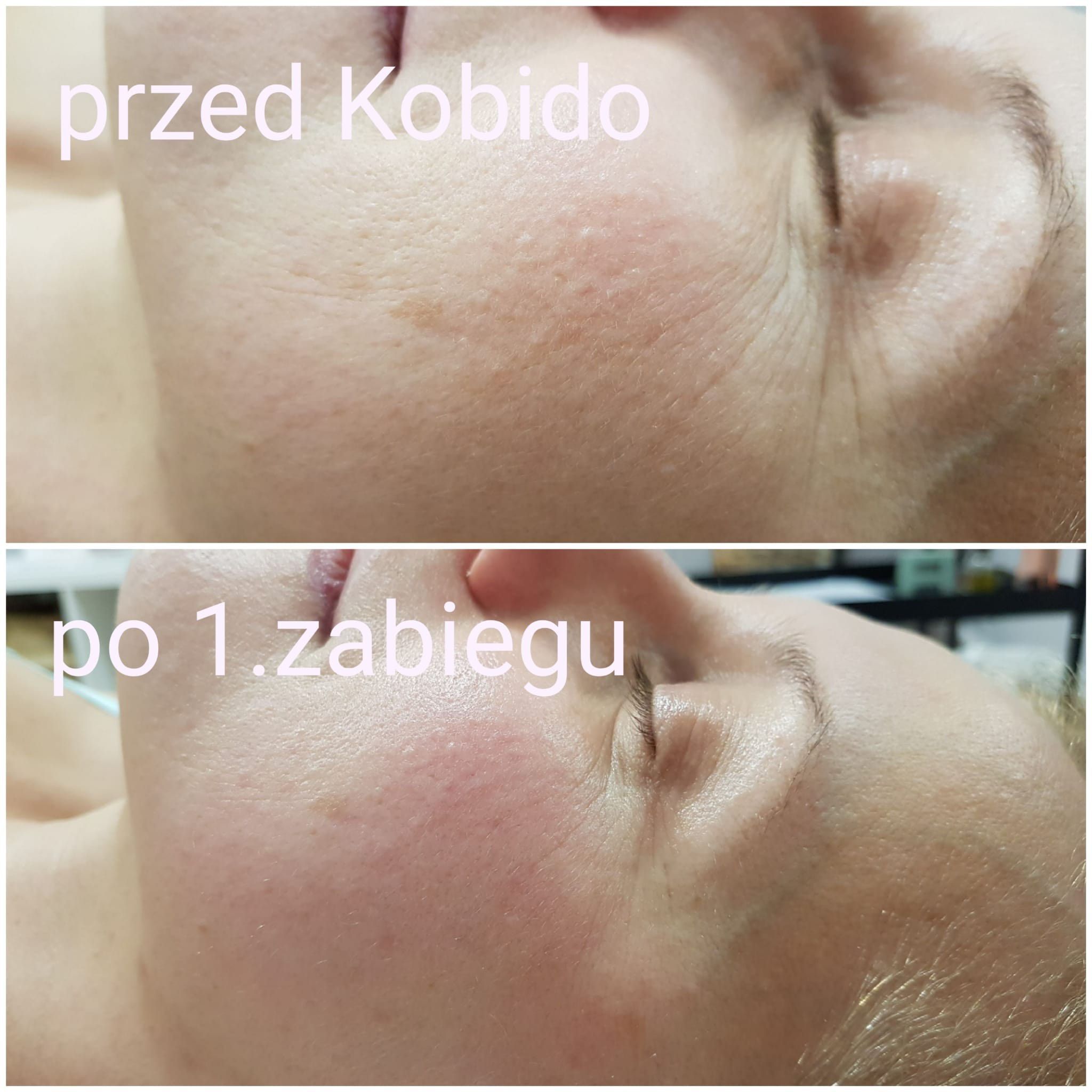 Portfolio usługi KOBIDO japoński masaż twarzy