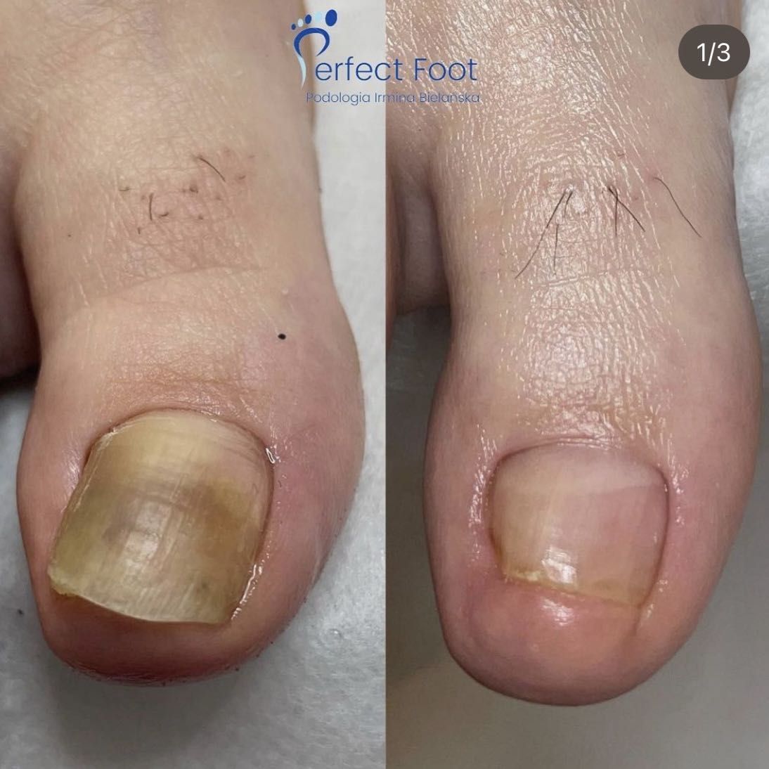 Portfolio usługi Opracowanie paznokcia zmienionego chorobowo