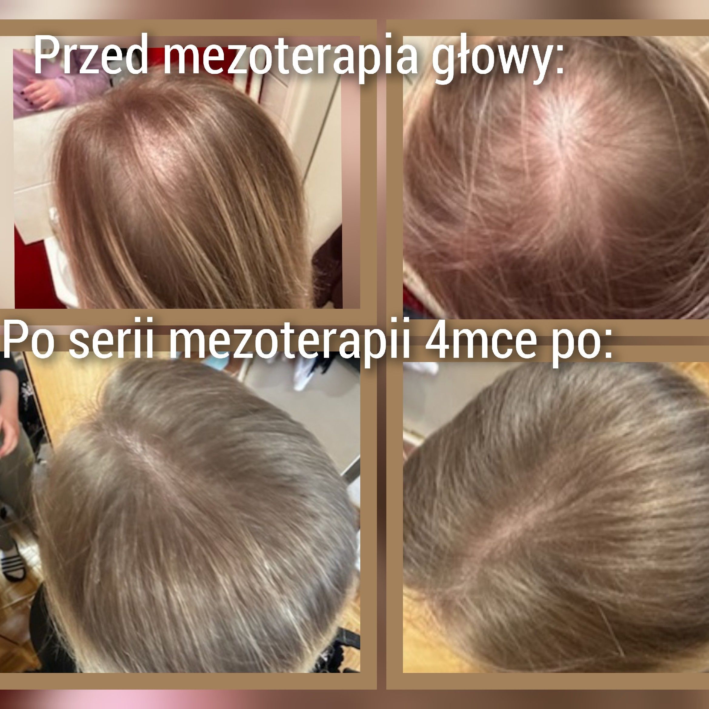 Portfolio usługi Mezoterapia skóry głowy