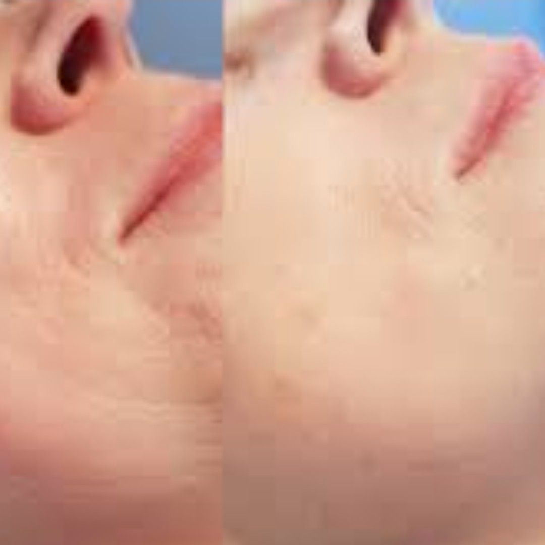 Portfolio usługi Mezoterapia igłowa (twarz +szyja)