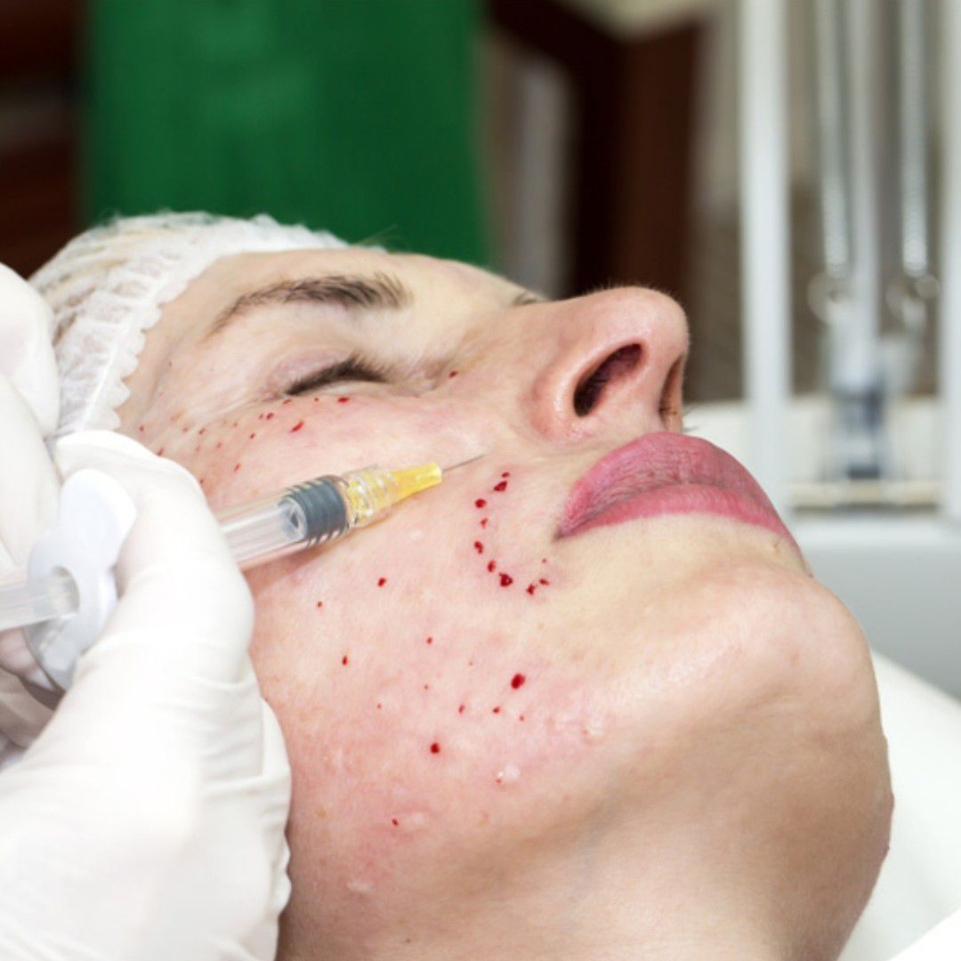 Portfolio usługi Mezoterapia igłowa (twarz +szyja)