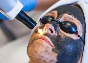 Portfolio usługi Carbon Peel - laserowy peeling węglowy twarzy