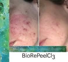 Portfolio usługi Peeling BioRePeel- biorewitalizacja skóry