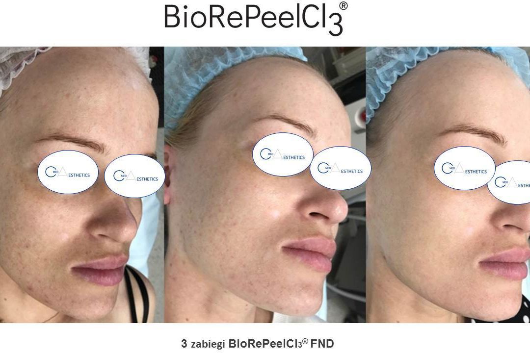 Portfolio usługi BioRePeel Cl3 - twarz+szyja+dekolt