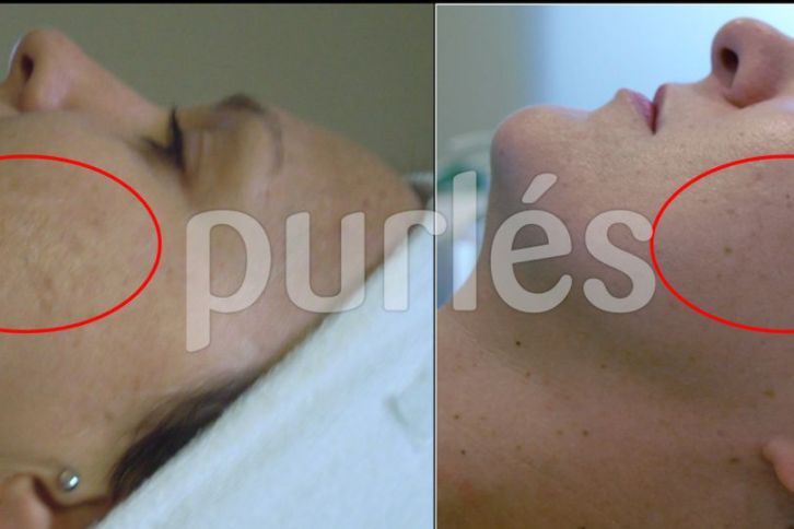 Portfolio usługi G-peel Intensywna regeneracja (skóra dojrzała)