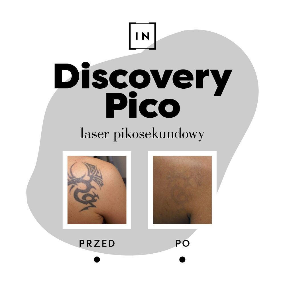 Portfolio usługi Discovery Pico Usuwanie przebarwień - pojedync...