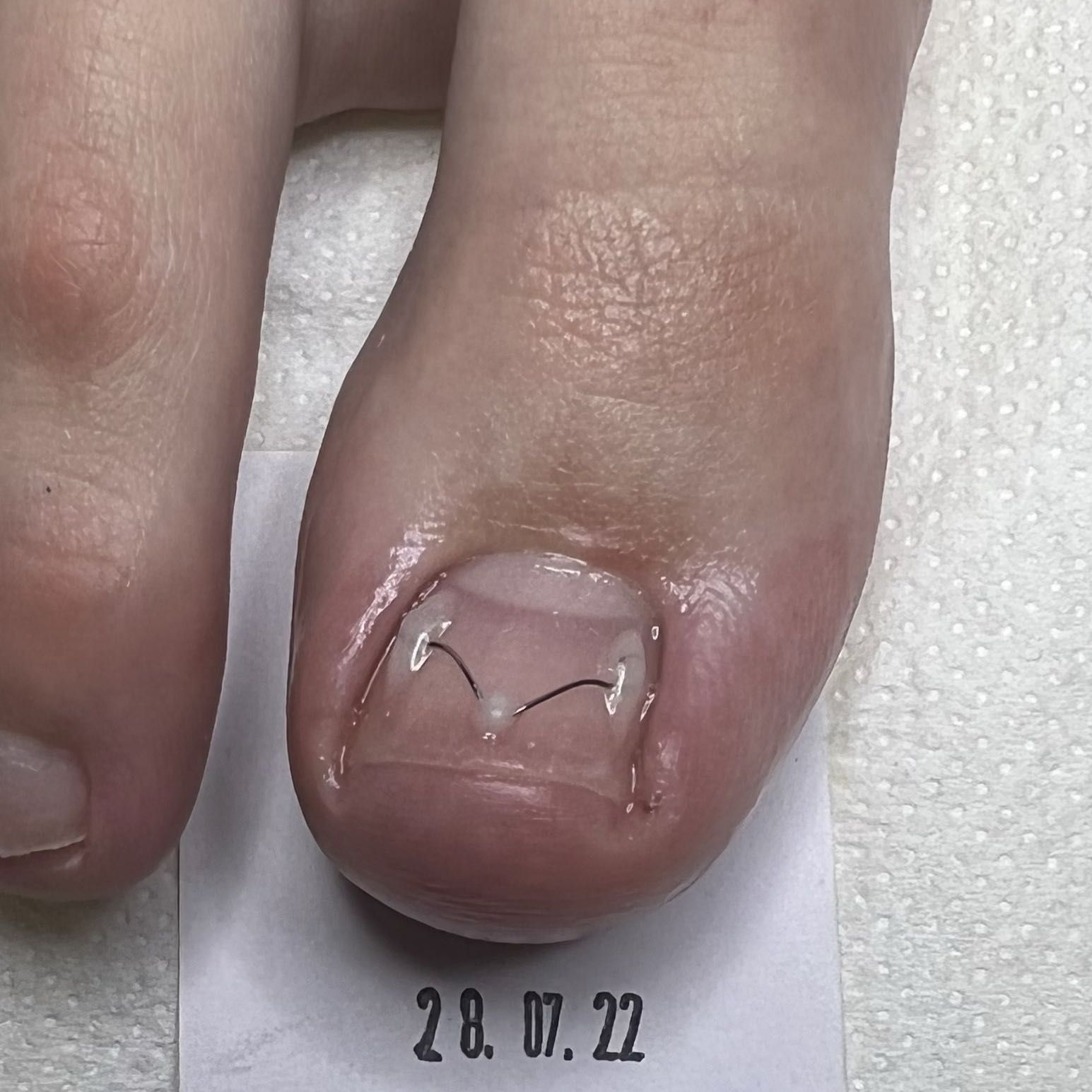 Portfolio usługi Klamra UniBrace na wrastające paznokcie