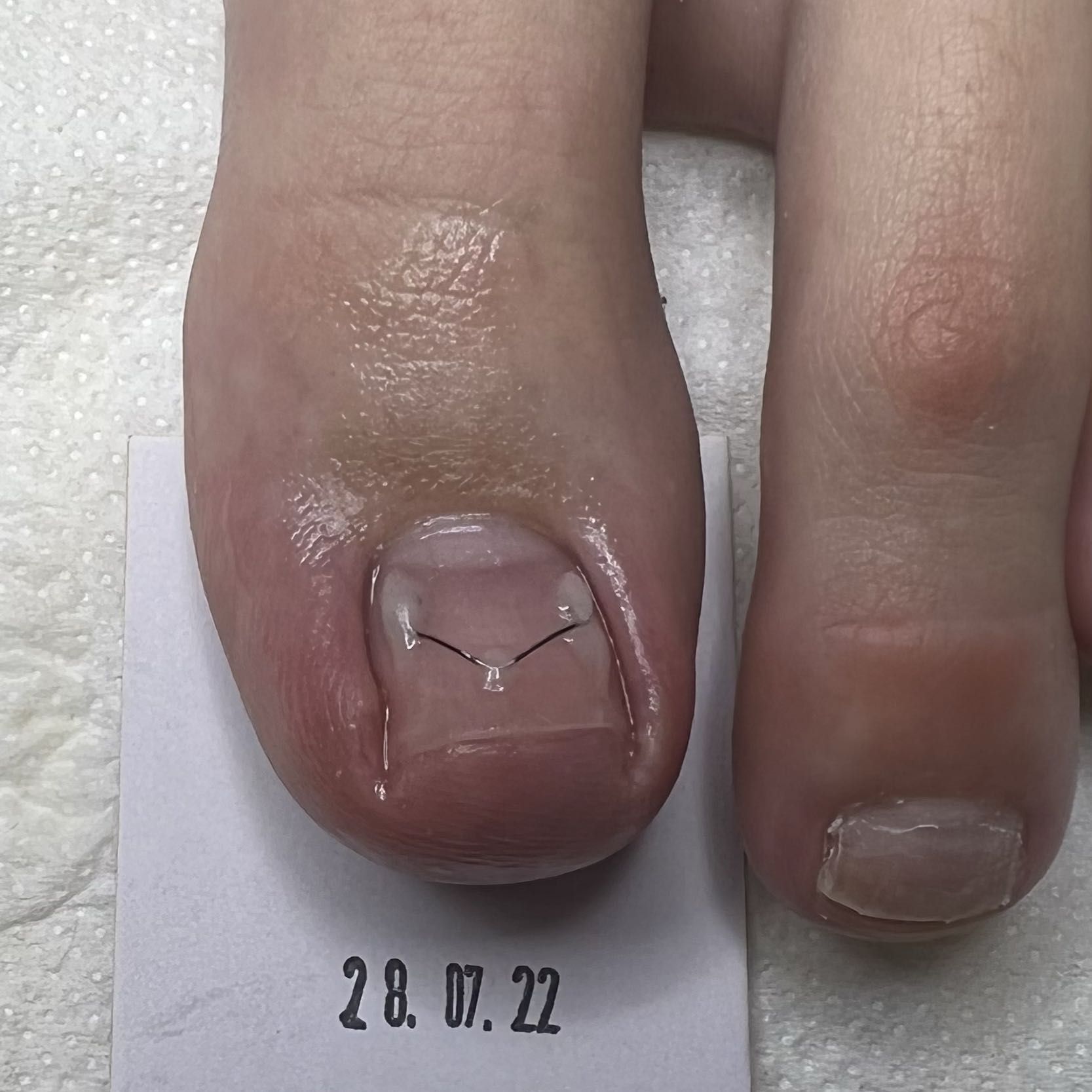 Portfolio usługi Klamra UniBrace na wrastające paznokcie