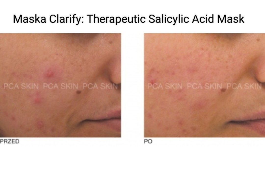 Portfolio usługi Detoxifying Pore Treatment + maska PCA
