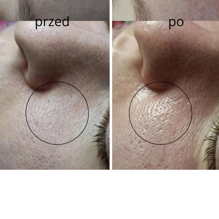 Portfolio usługi Detoxifying Pore Treatment + Oczyszczanie wodorowe