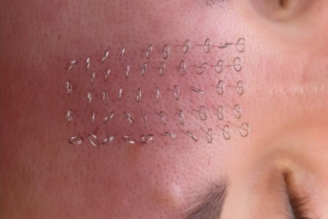 Portfolio usługi Akupunktura kosmetyczna - pinezkowanie twarzy