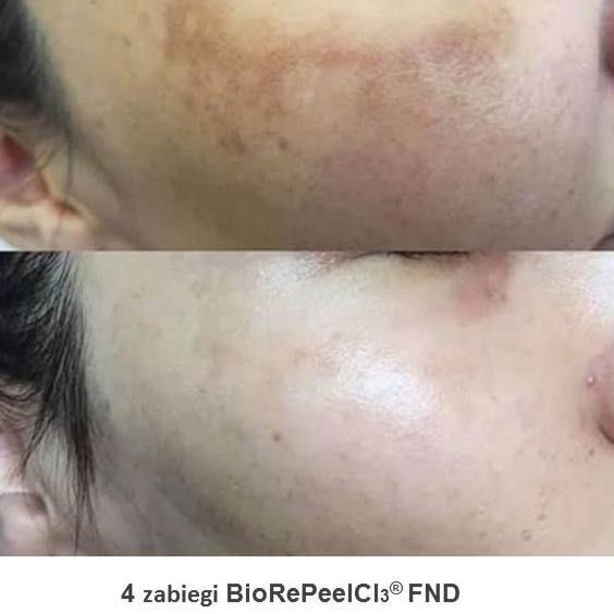 Portfolio usługi Peeling chemiczny twarz/ Biorepeel Cl3