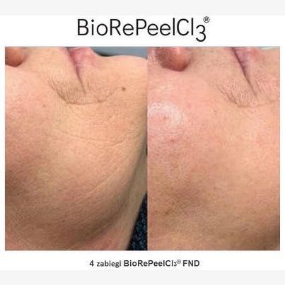Portfolio usługi Peeling chemiczny twarz/ Biorepeel Cl3