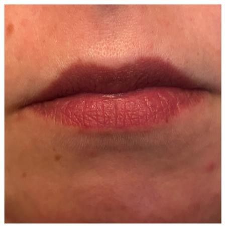 Portfolio usługi Lip Flip - modelowanie ust botoksem