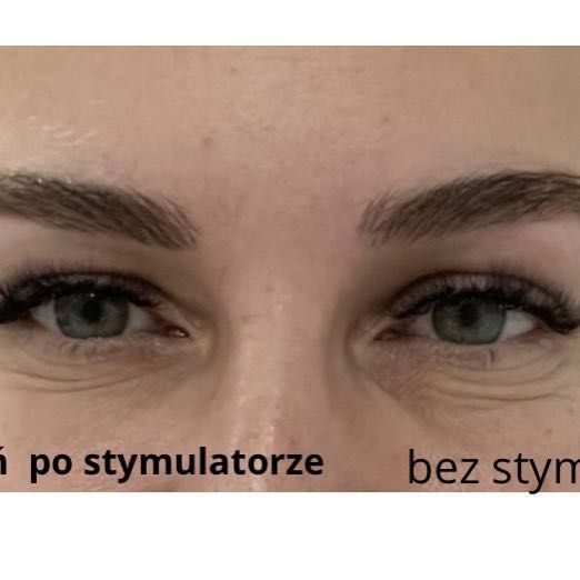 Portfolio usługi Stymulator tkankowy na okolice oczu
