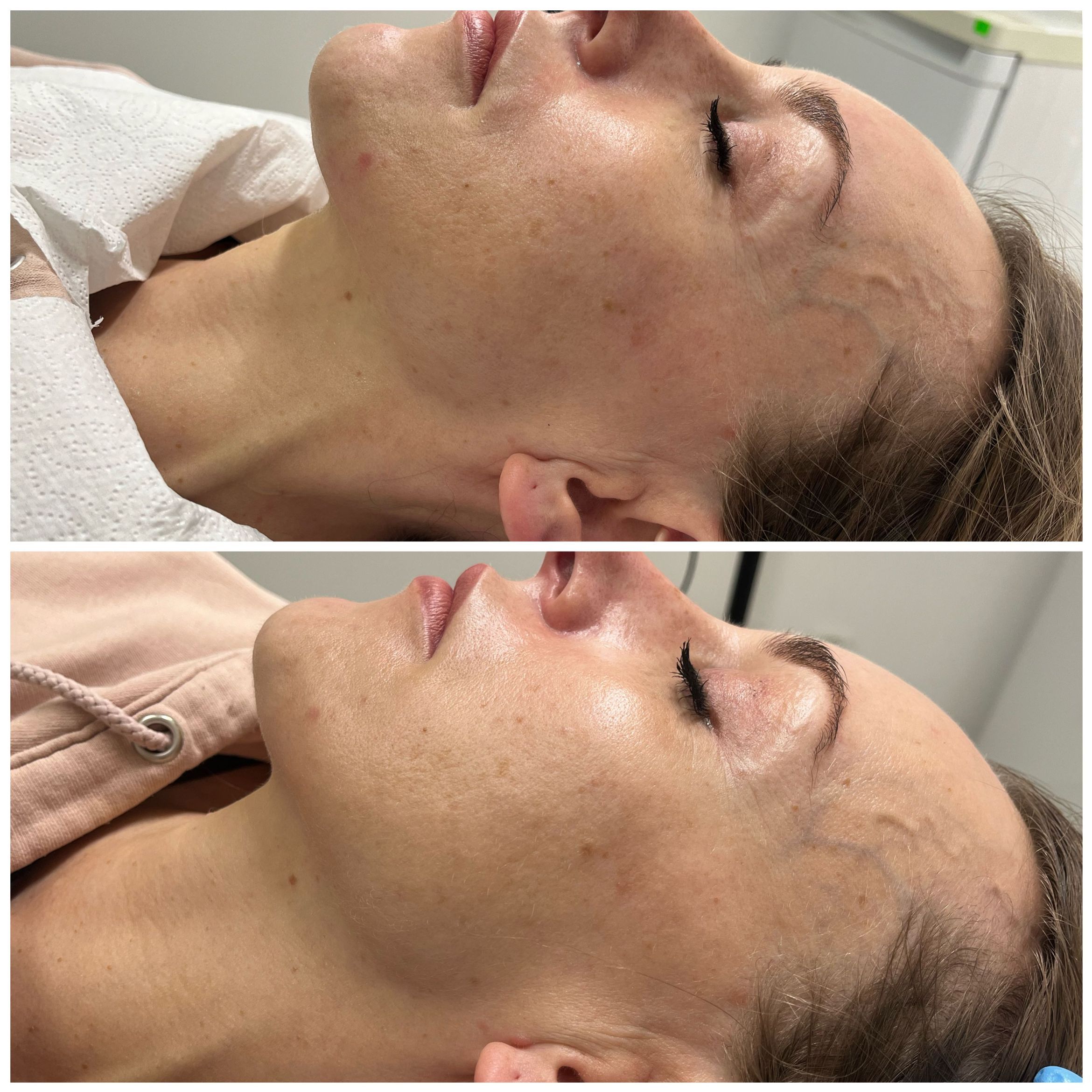 Portfolio usługi Laserowe odmladzanie skóry twarzy