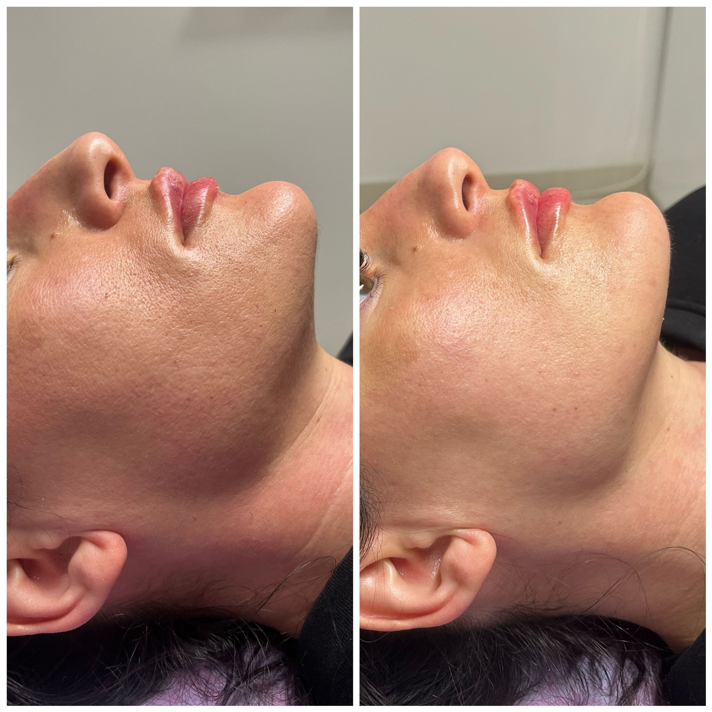 Portfolio usługi Laserowe odmladzanie skóry twarzy