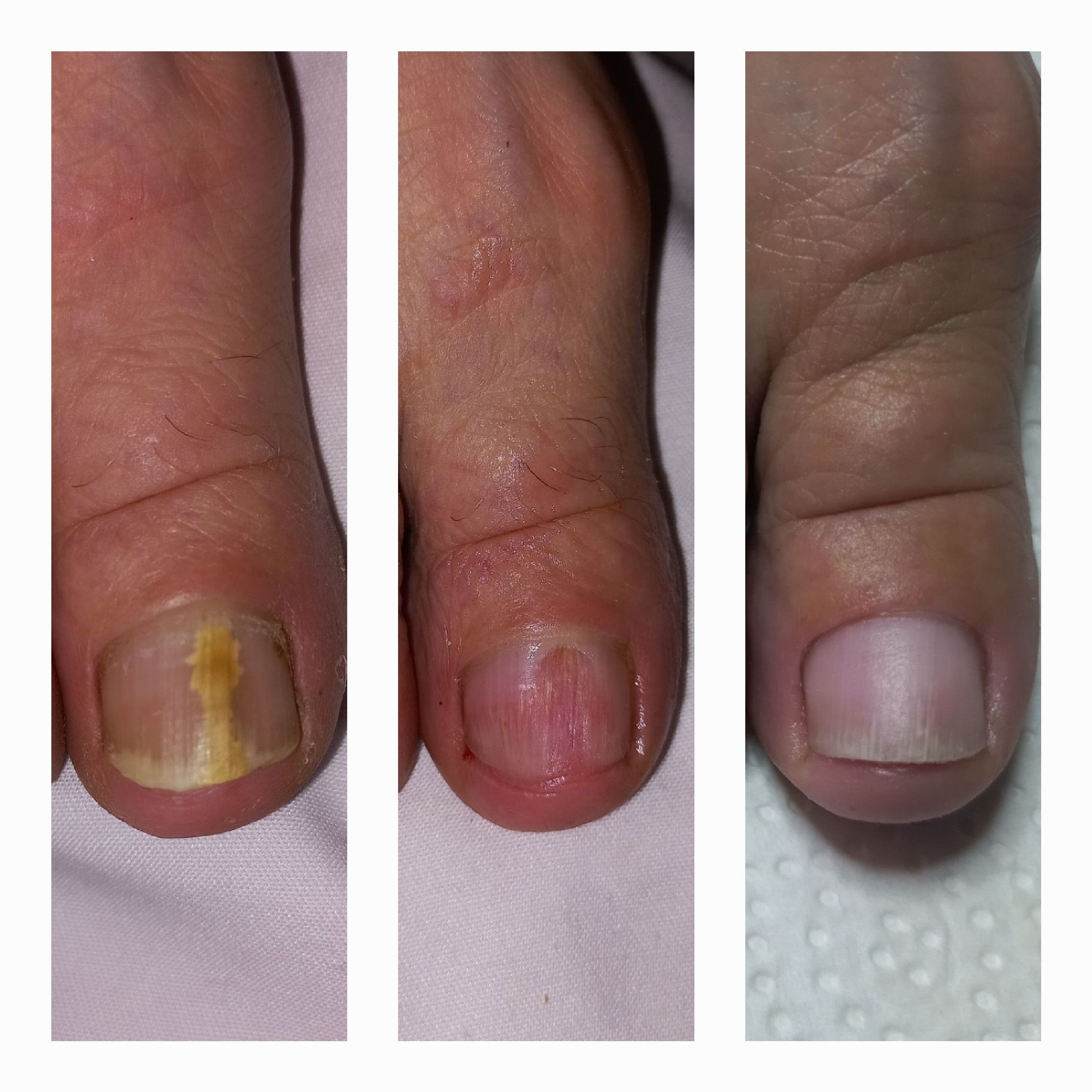 Portfolio usługi Oczyszczanie paznokcia zmienionego chorobowo