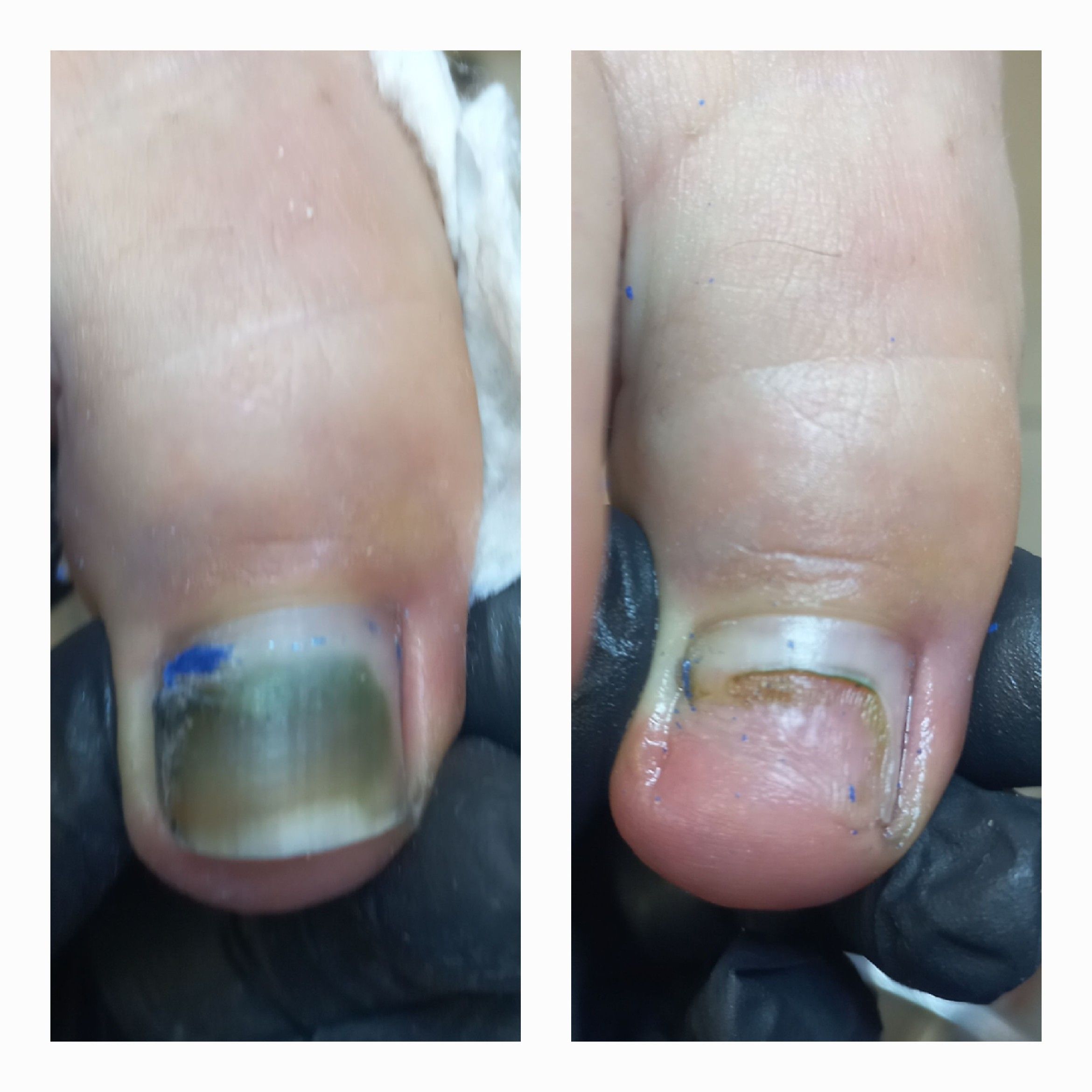 Portfolio usługi Oczyszczanie paznokcia zmienionego chorobowo