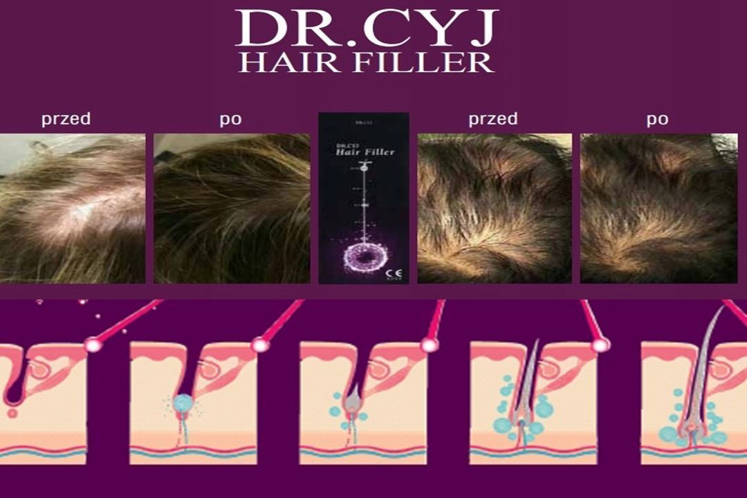 Portfolio usługi Dr.Cyj Hair Filler- mezoterapia igłowa skóry głowy