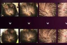 Portfolio usługi Dr.Cyj Hair Filler- mezoterapia igłowa skóry głowy