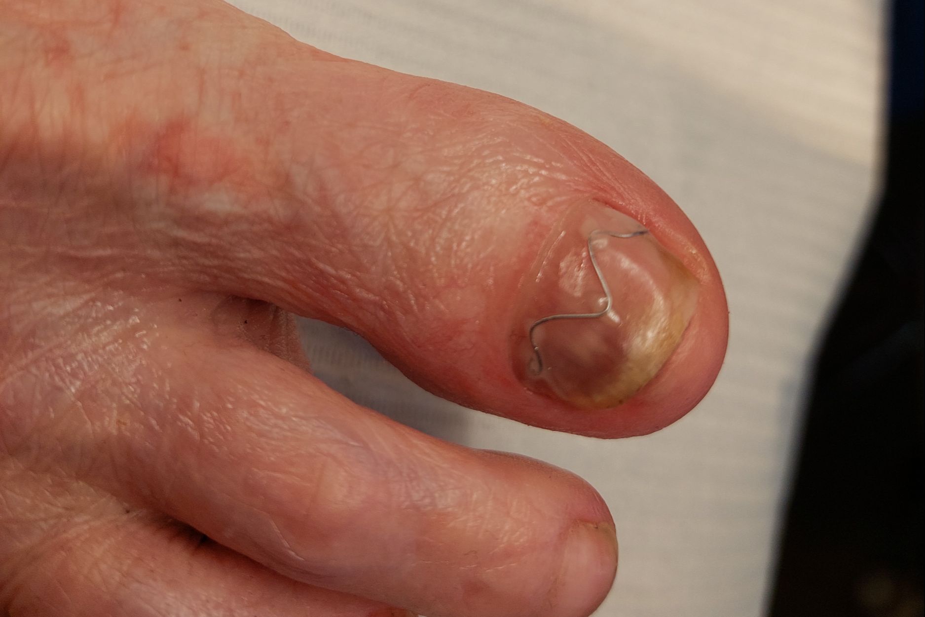 Portfolio usługi Wrastające paznokcie-rozpoczęcie terapii klamrą