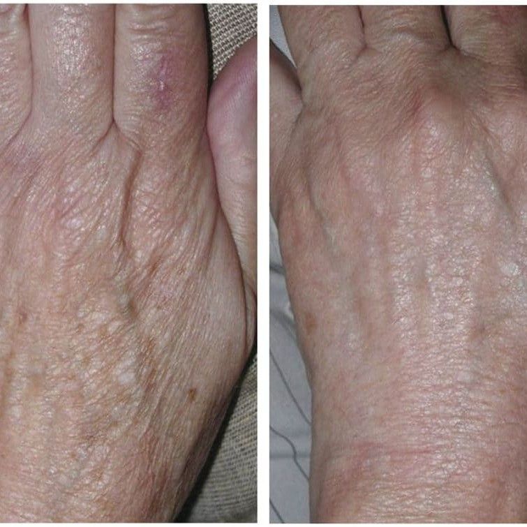 Portfolio usługi Mezoterapia skóry rąk