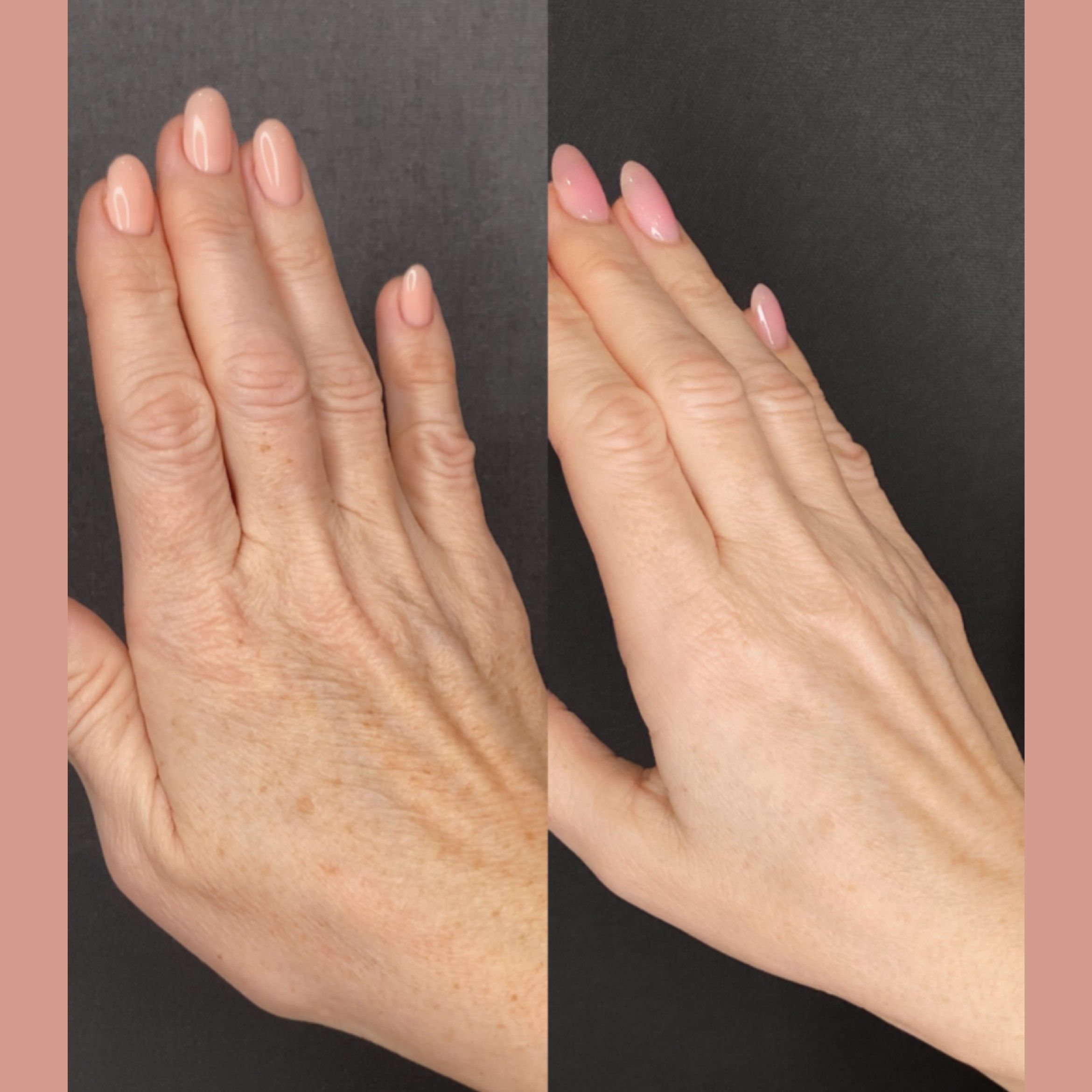 Portfolio usługi Mezoterapia skóry rąk