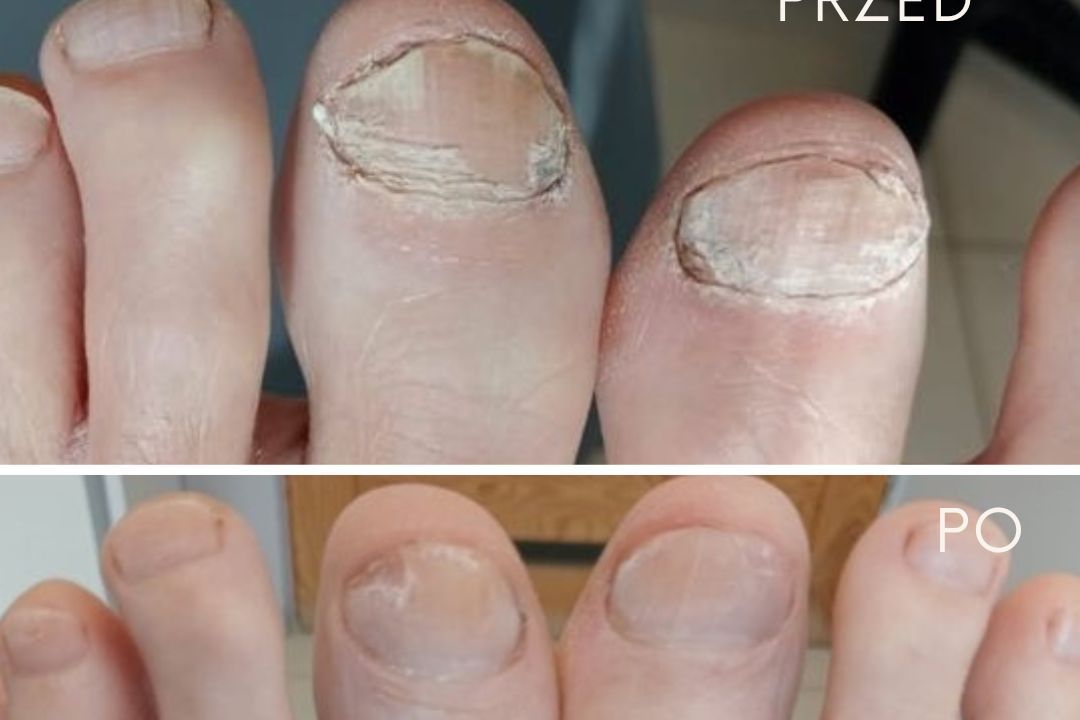 Portfolio usługi Terapia paznokci zmienionych chorobowo