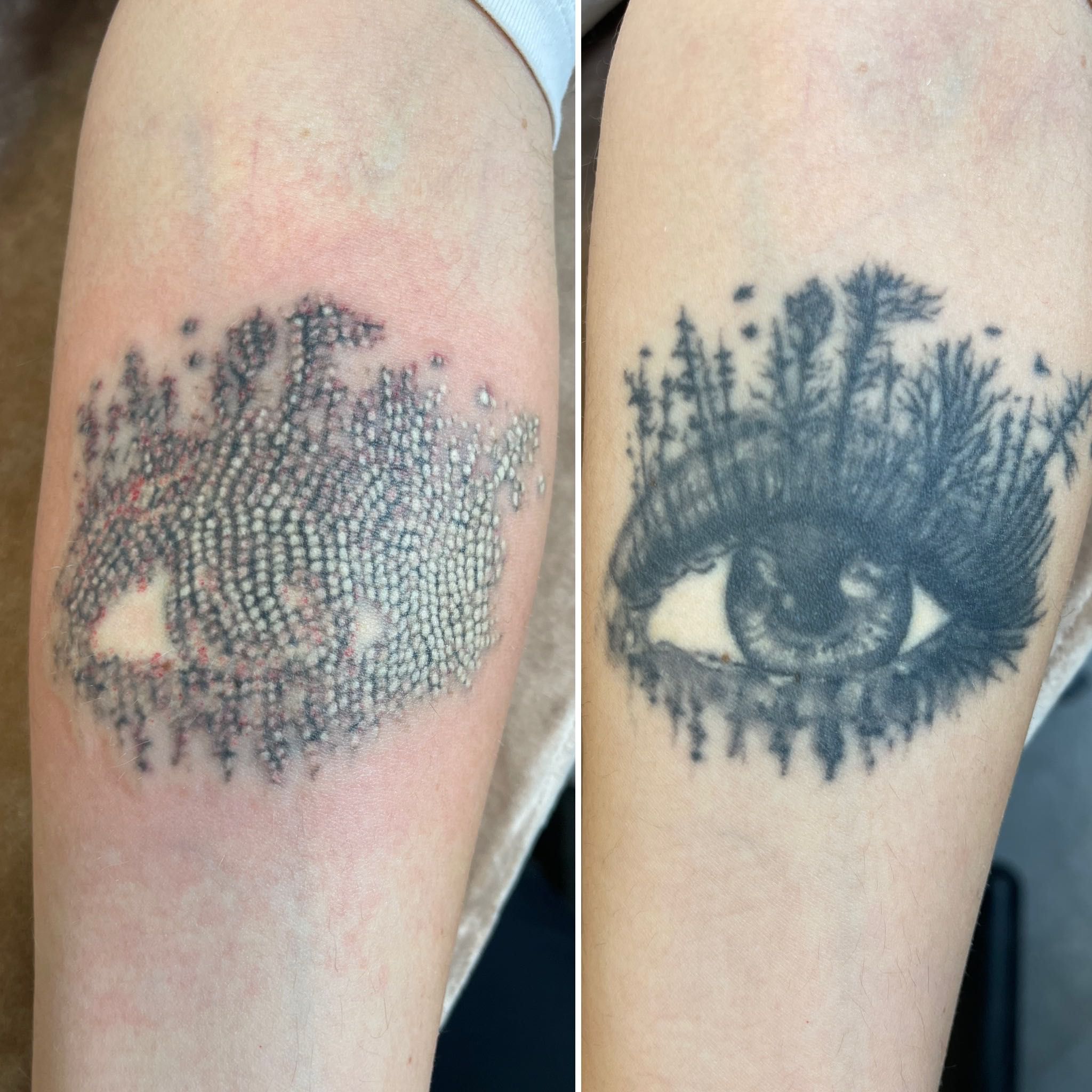 Portfolio usługi Usuwanie tatuażu od 10 cm