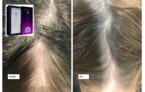 Portfolio usługi Dr. Cyj Hair Filler Mezoterapia igłowa skóry głowy