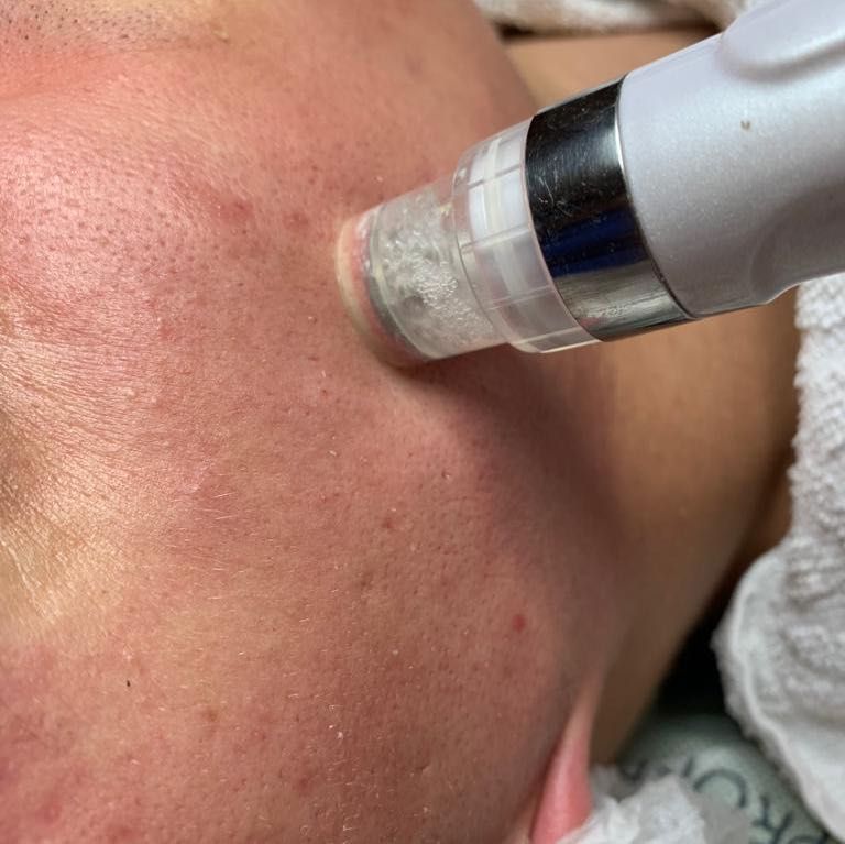 Portfolio usługi Wodoroterapia twarz, szyja+infuzja tlenowa GRATIS