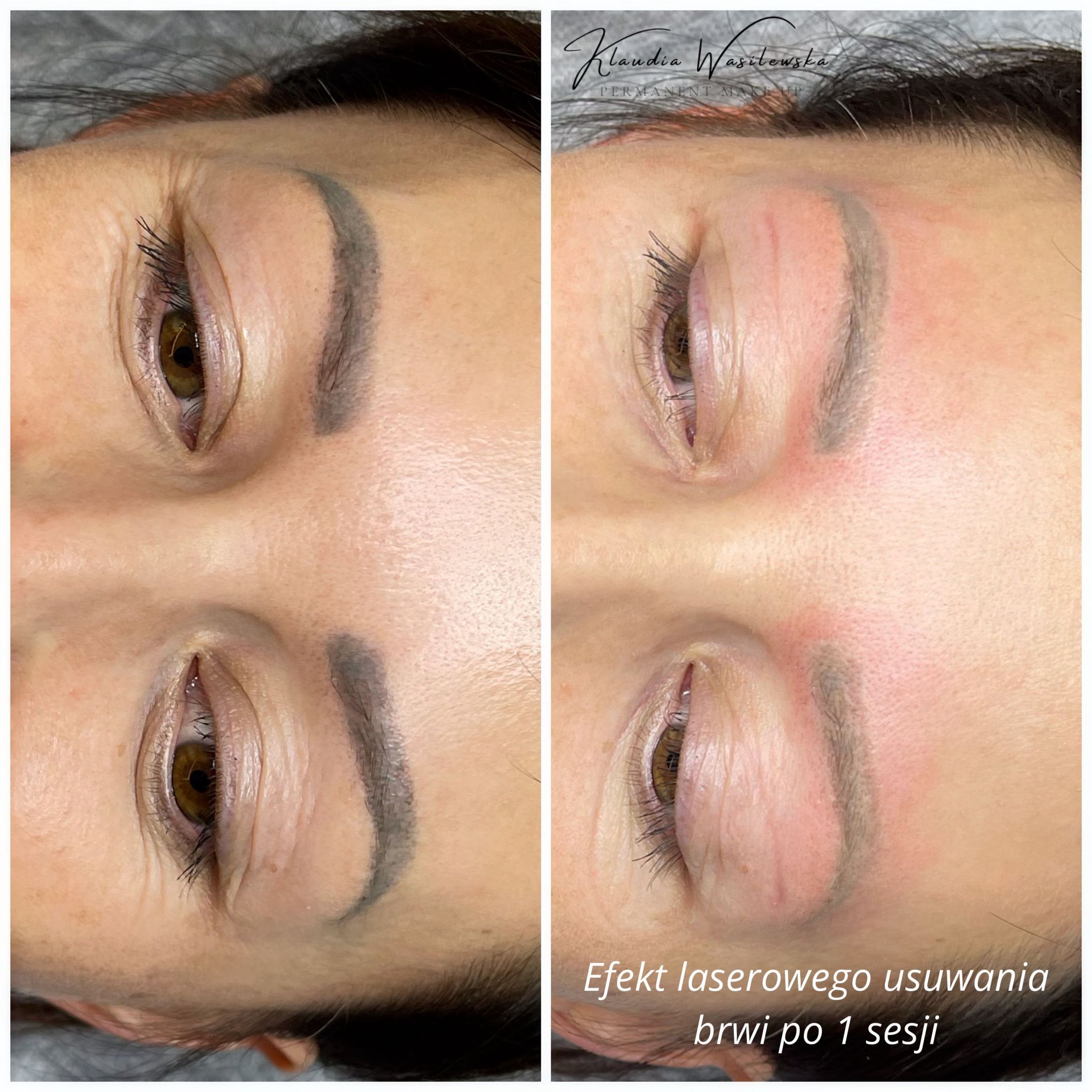 Portfolio usługi Laserowe usuwanie makijażu permanentnego brwi