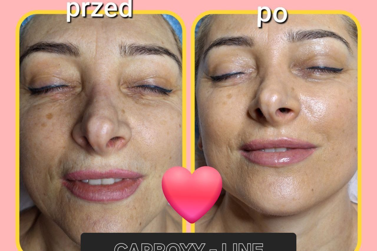 Portfolio usługi Karboksyterapia twarzy+maska algi
