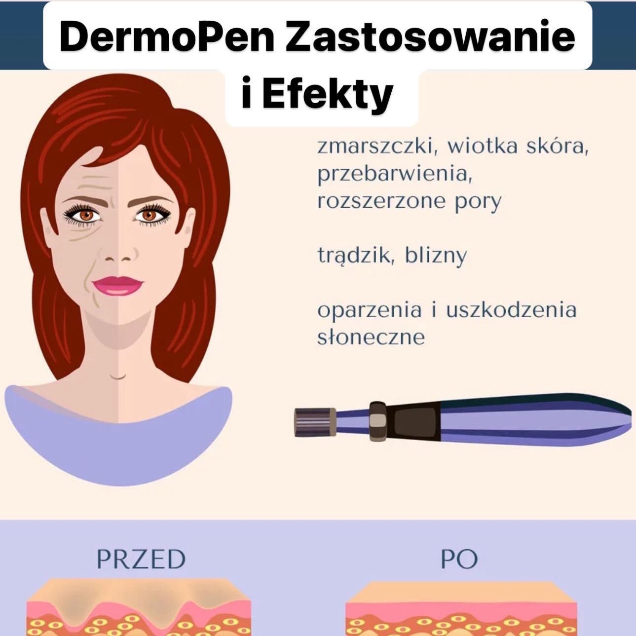 Portfolio usługi Mezoterapia Mikroigłowa Dermo Pen-twarz+ampułka