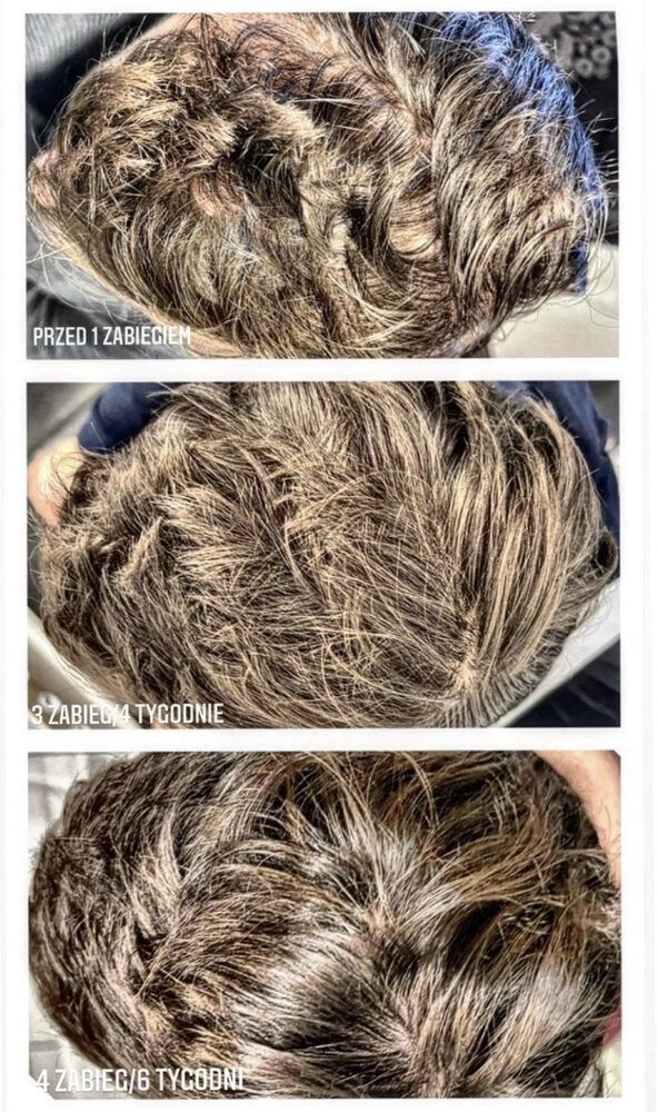 Portfolio usługi Dr Cyj- mezoterapia włosów i skory owłosionej