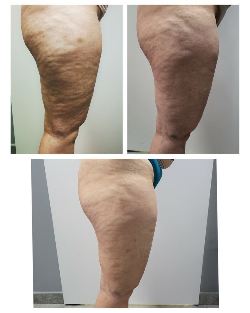 Portfolio usługi Karboksyterapia - Całe nogi