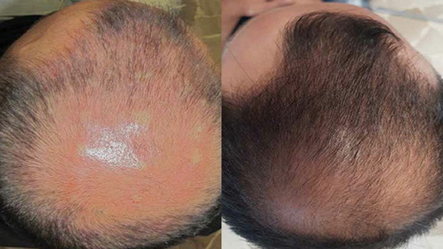 Portfolio usługi mezoterapia głowy/porost włosów