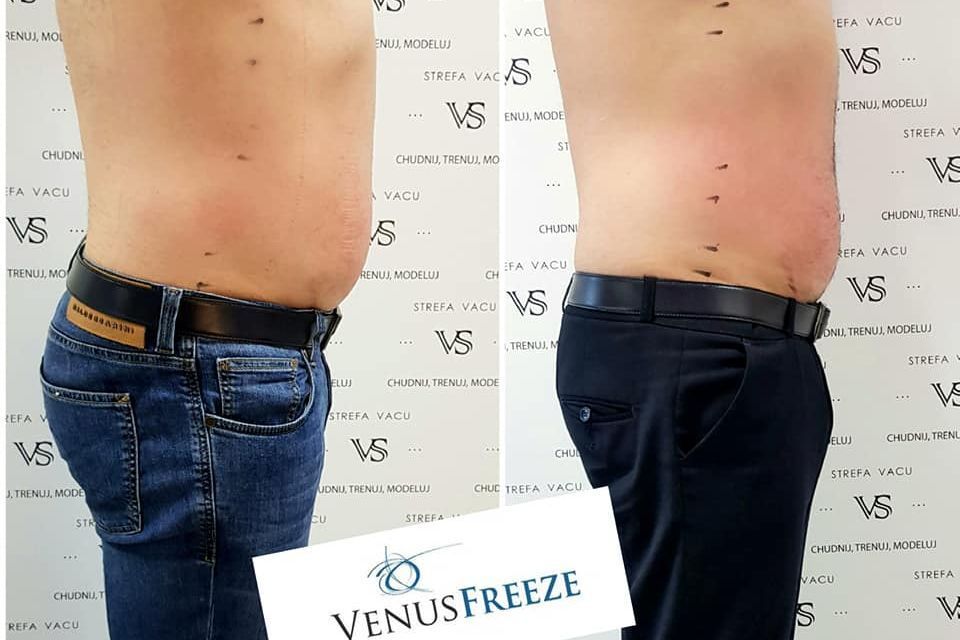 Portfolio usługi Venus Freeze BRZUCH
