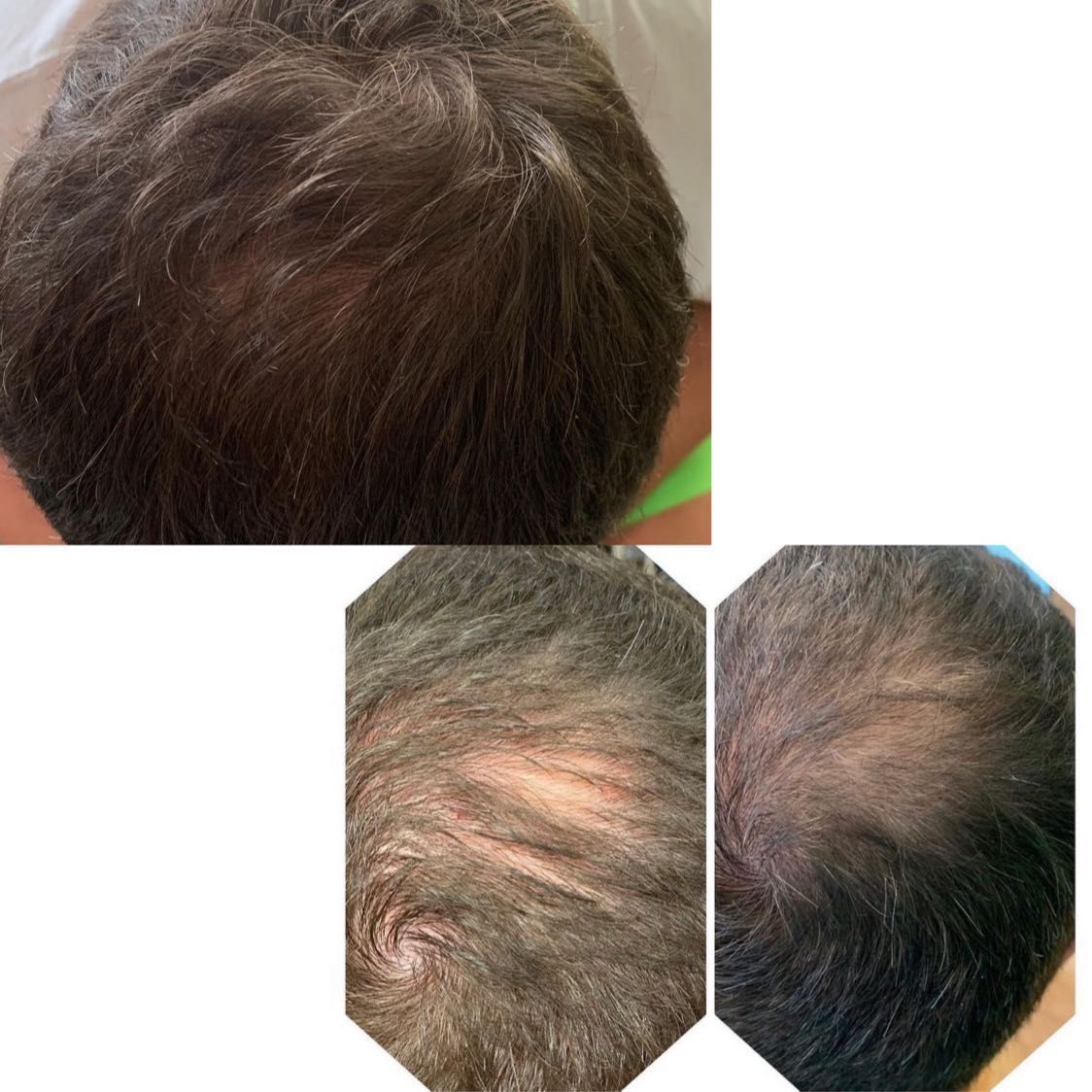 Portfolio usługi Mezoterapia skóry głowy (pobudza wzrost włosów)