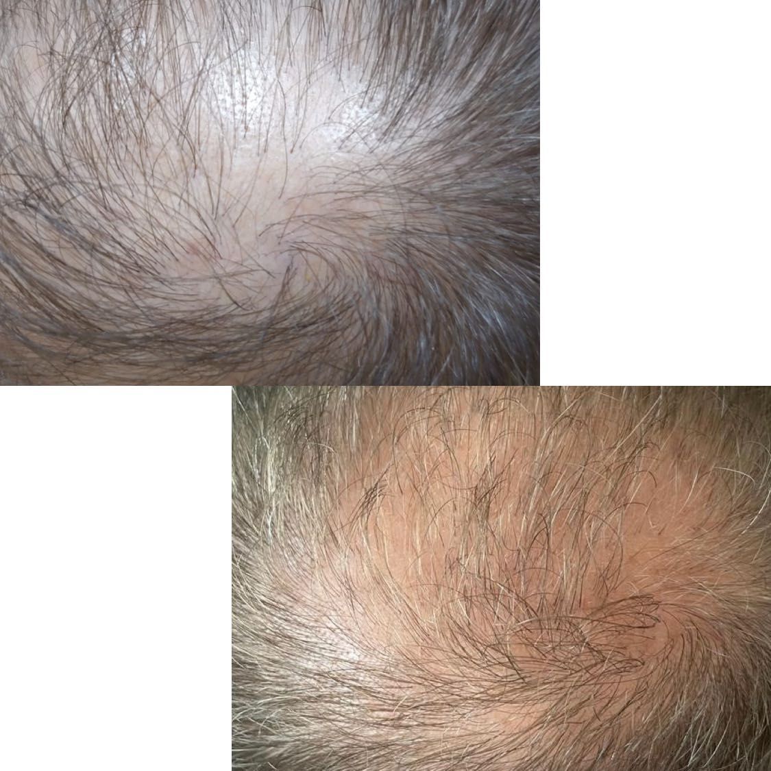 Portfolio usługi Mezoterapia skóry głowy (pobudza wzrost włosów)