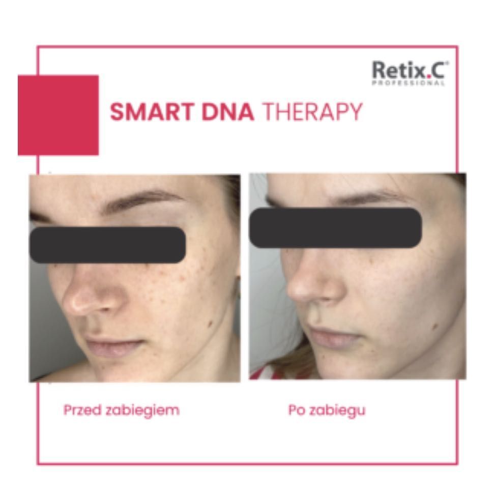 Portfolio usługi Retix Smart DNA therapy- ferulowy